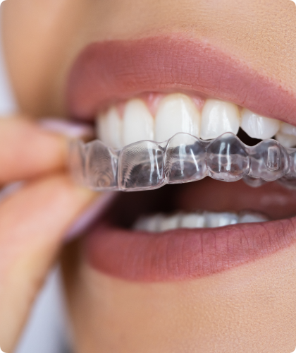 close up of woman putting in Invisalign aligner