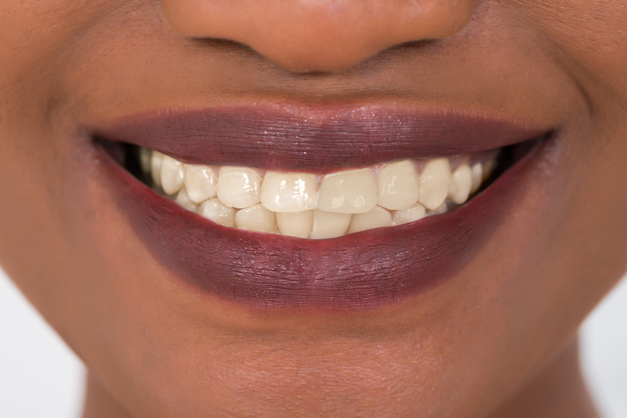 Before Zoom Teeth Whitening