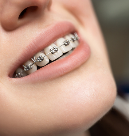 Braces