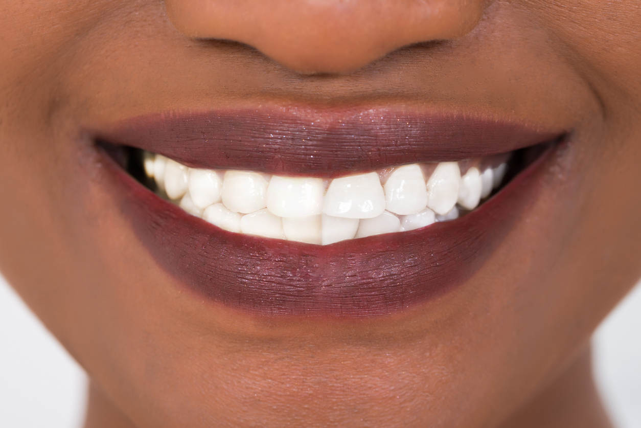Zoom Teeth Whitening After