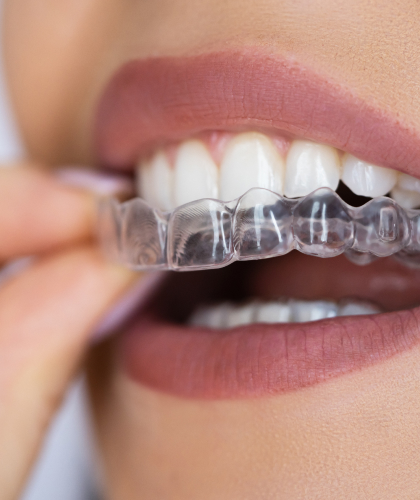 Invisalign