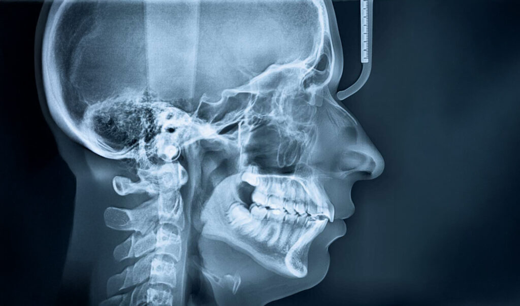 Airway Orthodontics At Orthodontic Boutique